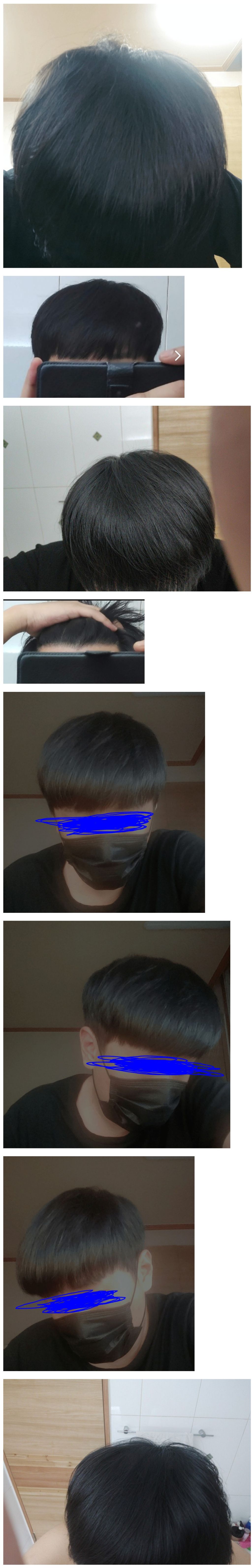 모발이식에 천만원 투자 한 38살