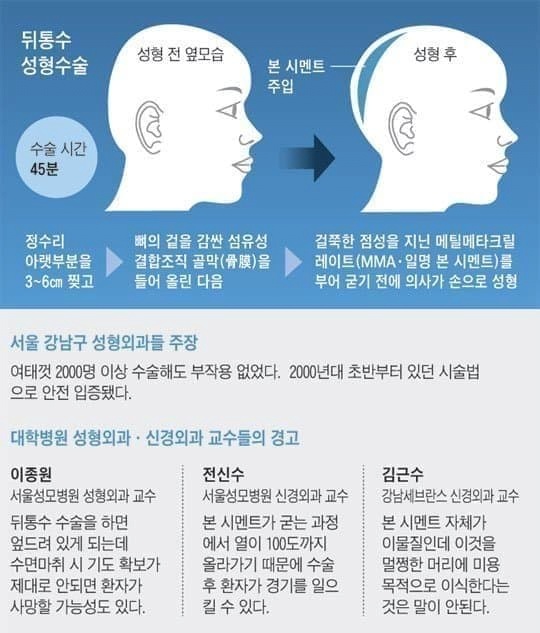 무시무시한 요즘 성형수술
