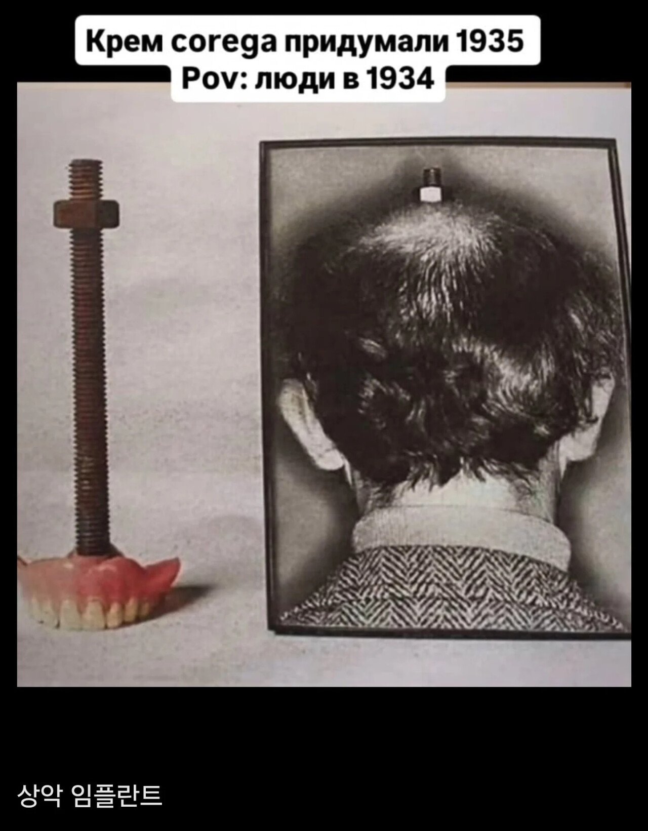 1930년대식 임플란트