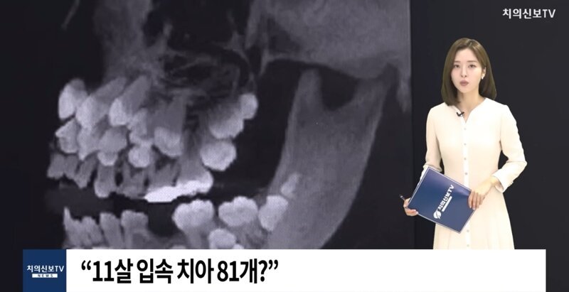 브라질 치아가 81개인 11살