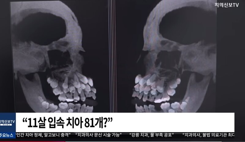 브라질 치아가 81개인 11살
