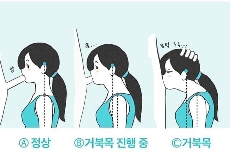 거북목 진단법 ㄷㄷㄷㄷㄷㄷ