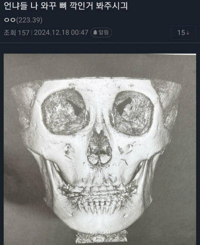 윤곽수술하면 뼈 이렇게 깎는구나...