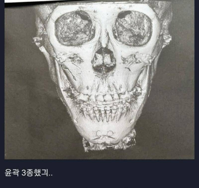 윤곽수술하면 뼈 이렇게 깎는구나...