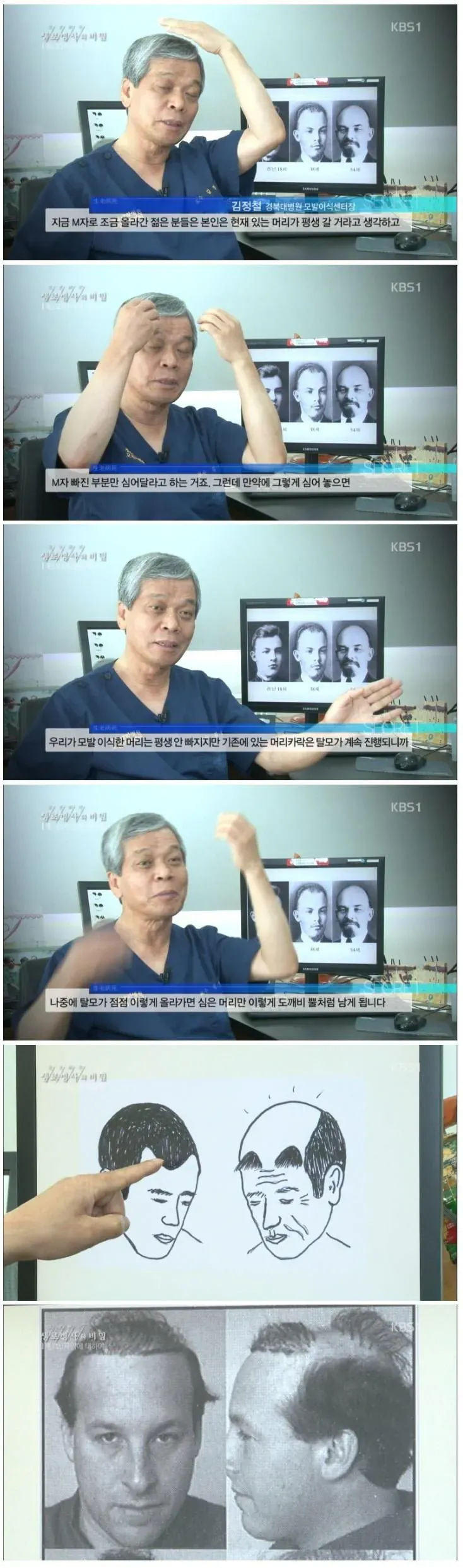 M자 탈모의 위험성